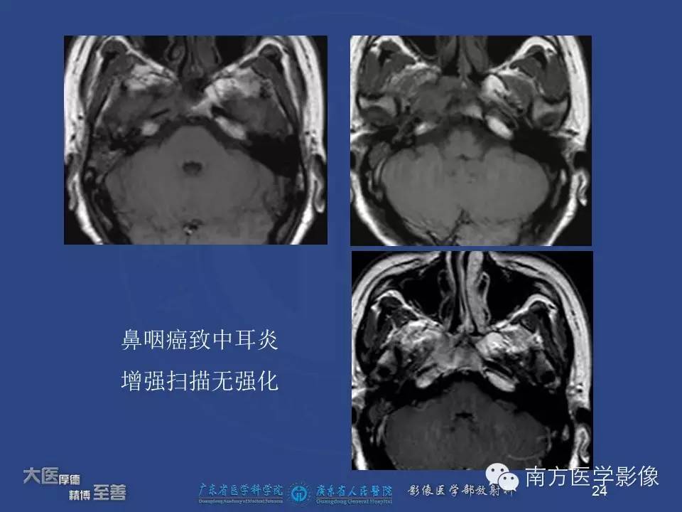影像PPT - 【PPT】鼻咽癌累及中耳及与中耳炎的鉴别-24