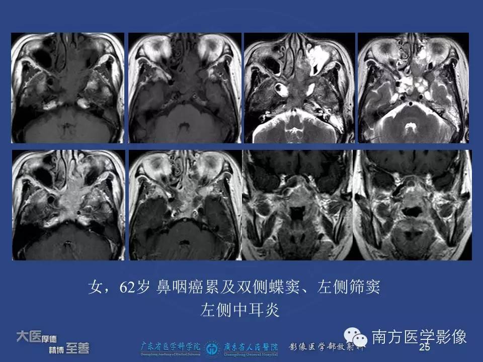 影像PPT - 【PPT】鼻咽癌累及中耳及与中耳炎的鉴别-25