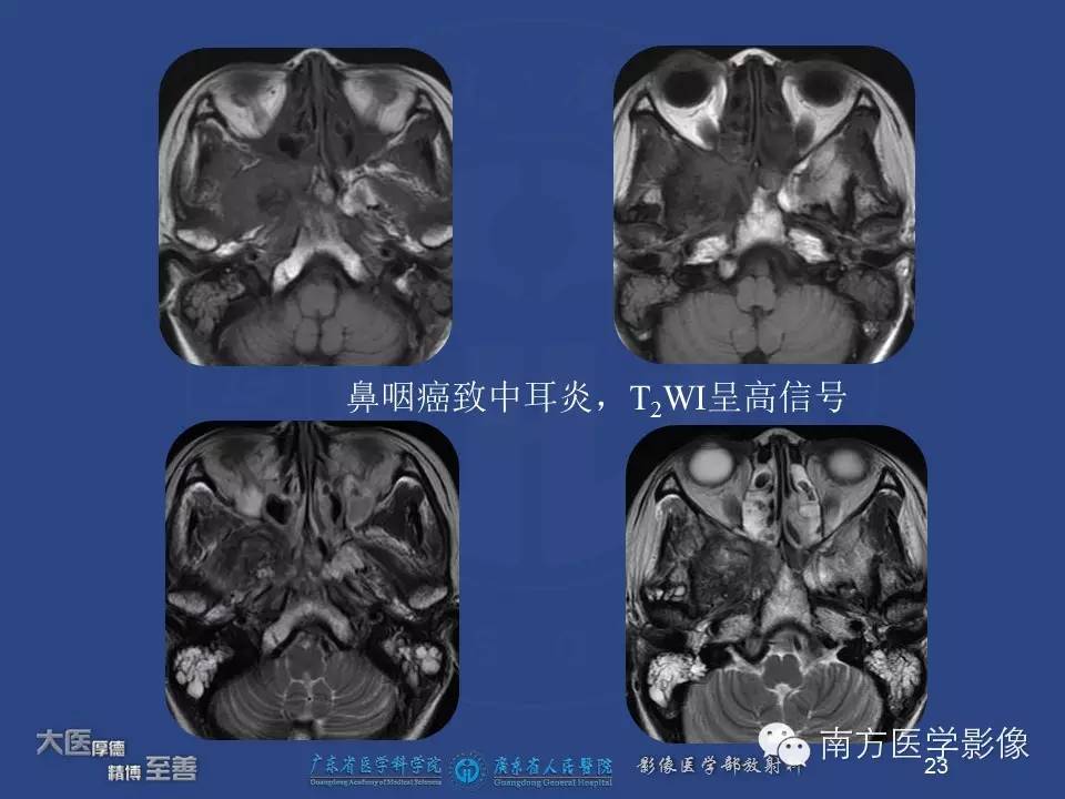影像PPT - 【PPT】鼻咽癌累及中耳及与中耳炎的鉴别-23