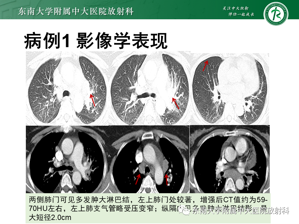 影像PPT - 【PPT】肺结节病-2