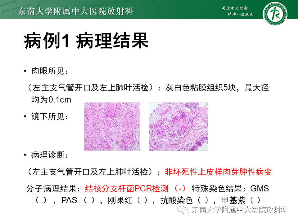 影像PPT - 【PPT】肺结节病-4