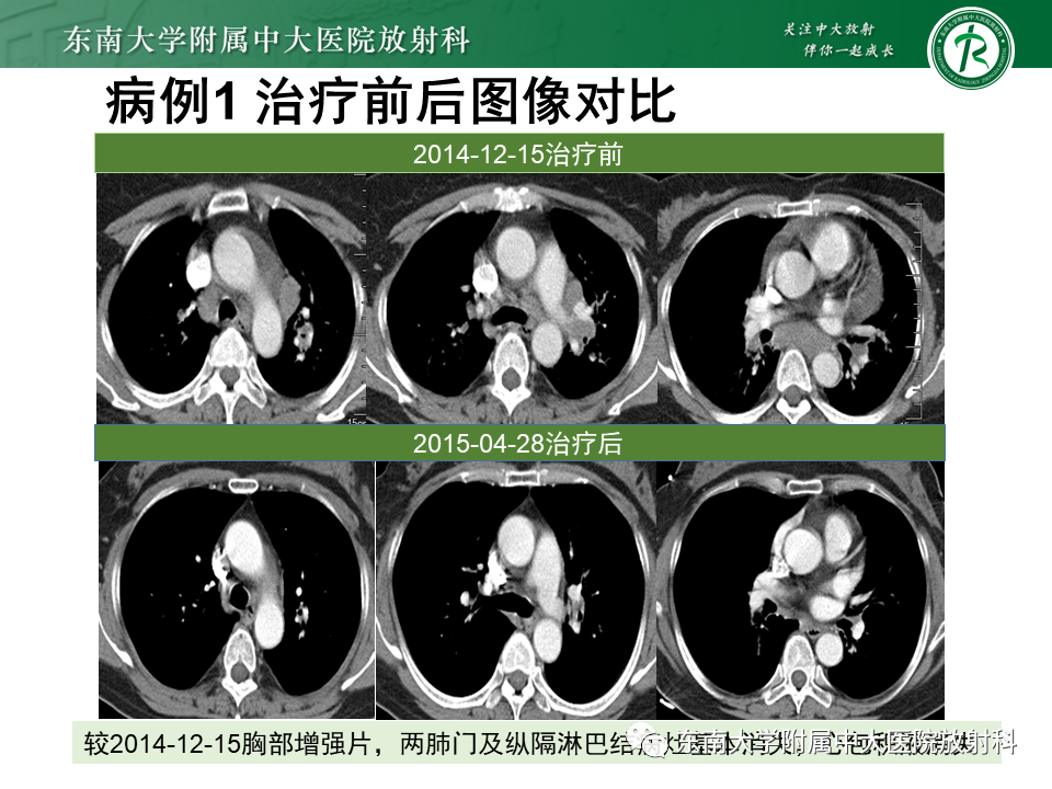 影像PPT - 【PPT】肺结节病-6