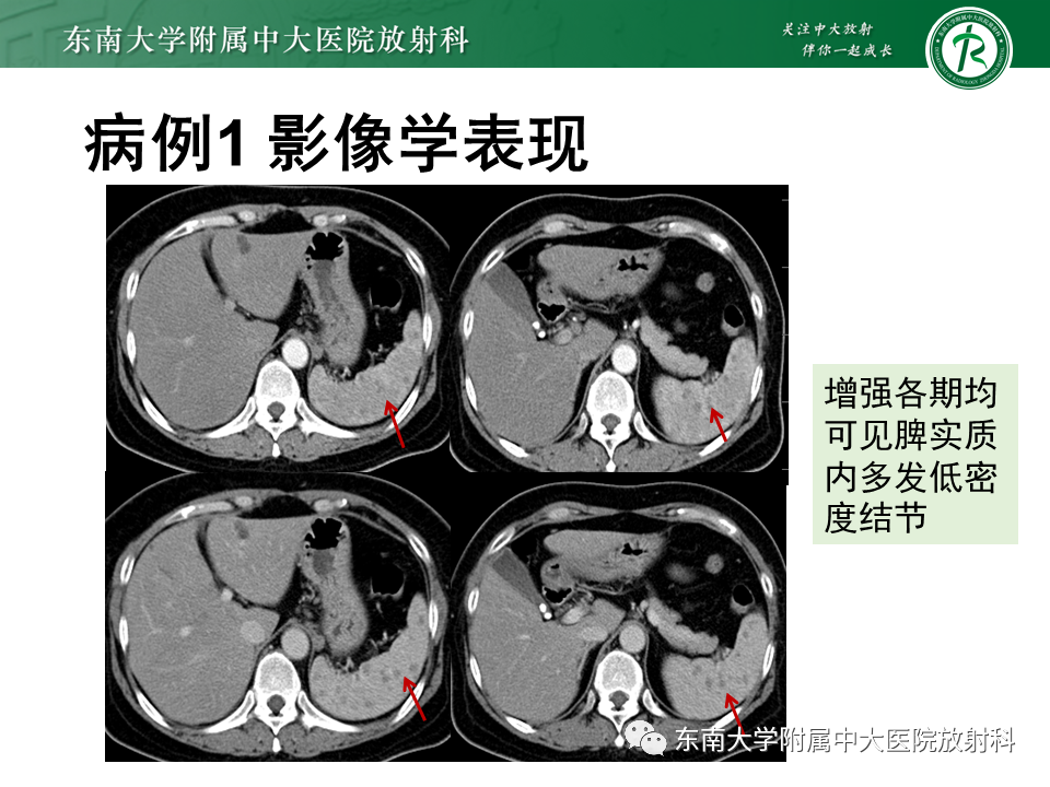 影像PPT - 【PPT】肺结节病-3