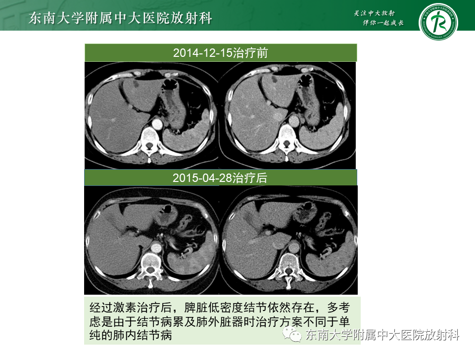 影像PPT - 【PPT】肺结节病-7