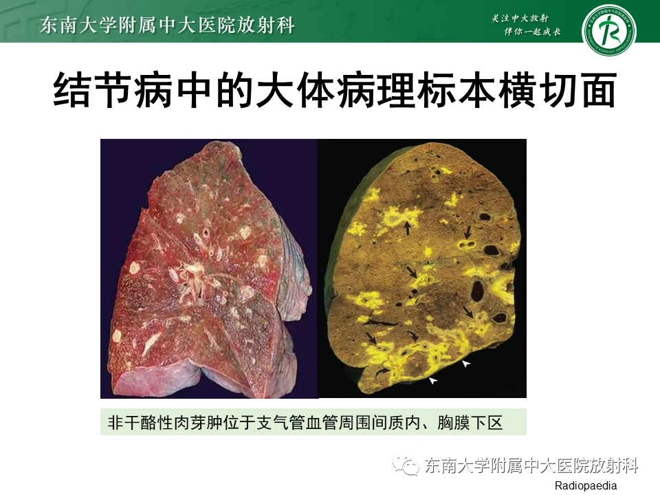 影像PPT - 【PPT】肺结节病-13