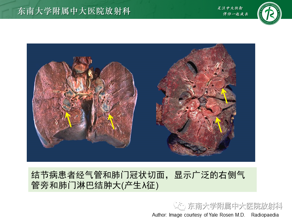 影像PPT - 【PPT】肺结节病-14