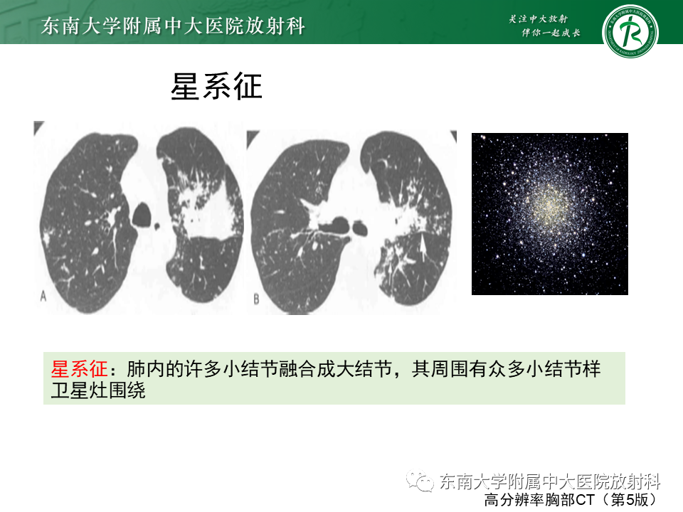 影像PPT - 【PPT】肺结节病-17
