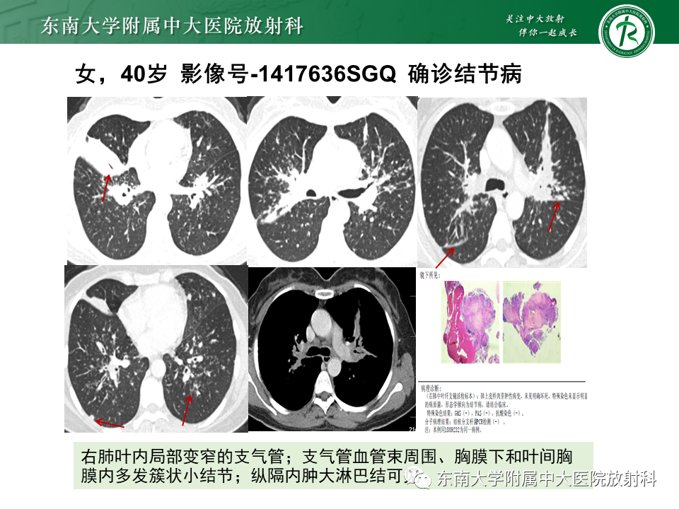 影像PPT - 【PPT】肺结节病-20