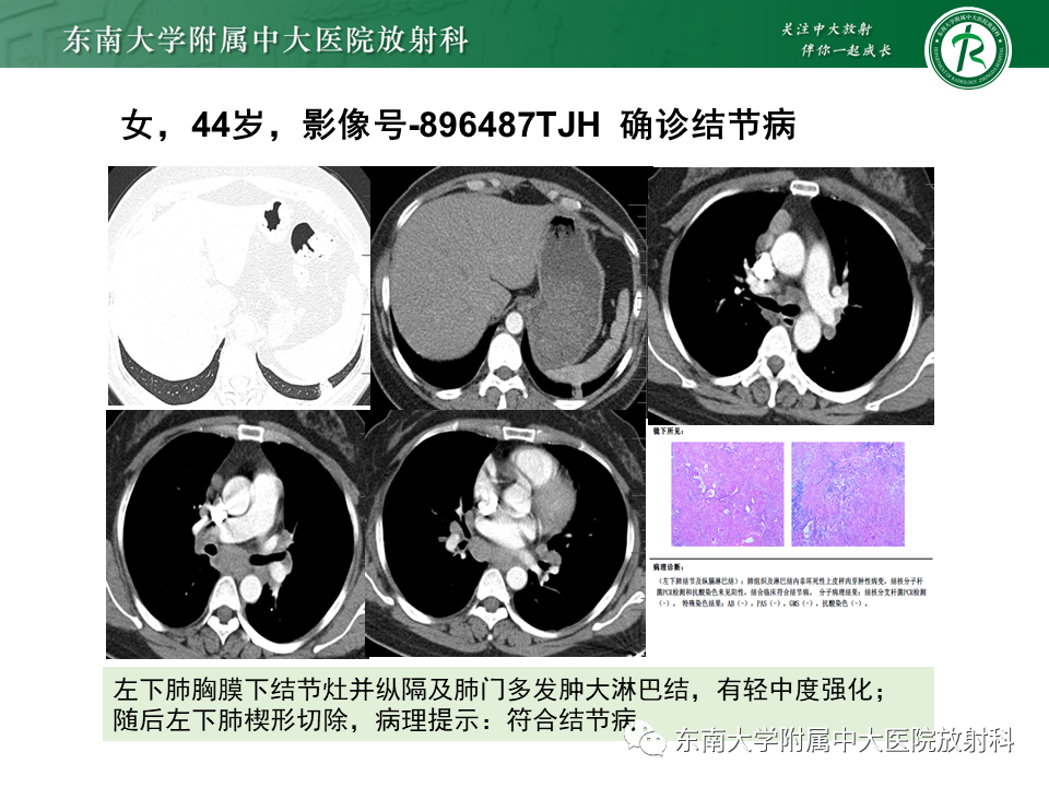 影像PPT - 【PPT】肺结节病-21