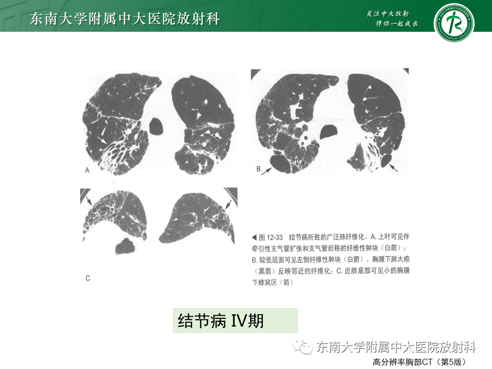 影像PPT - 【PPT】肺结节病-22