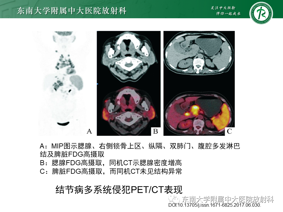 影像PPT - 【PPT】肺结节病-24
