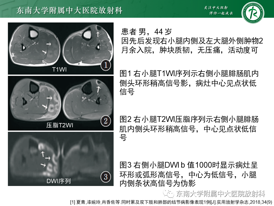 影像PPT - 【PPT】肺结节病-25