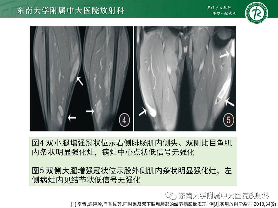 影像PPT - 【PPT】肺结节病-26