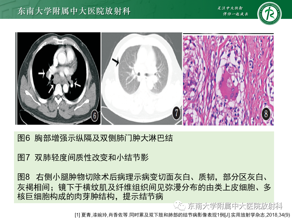 影像PPT - 【PPT】肺结节病-27