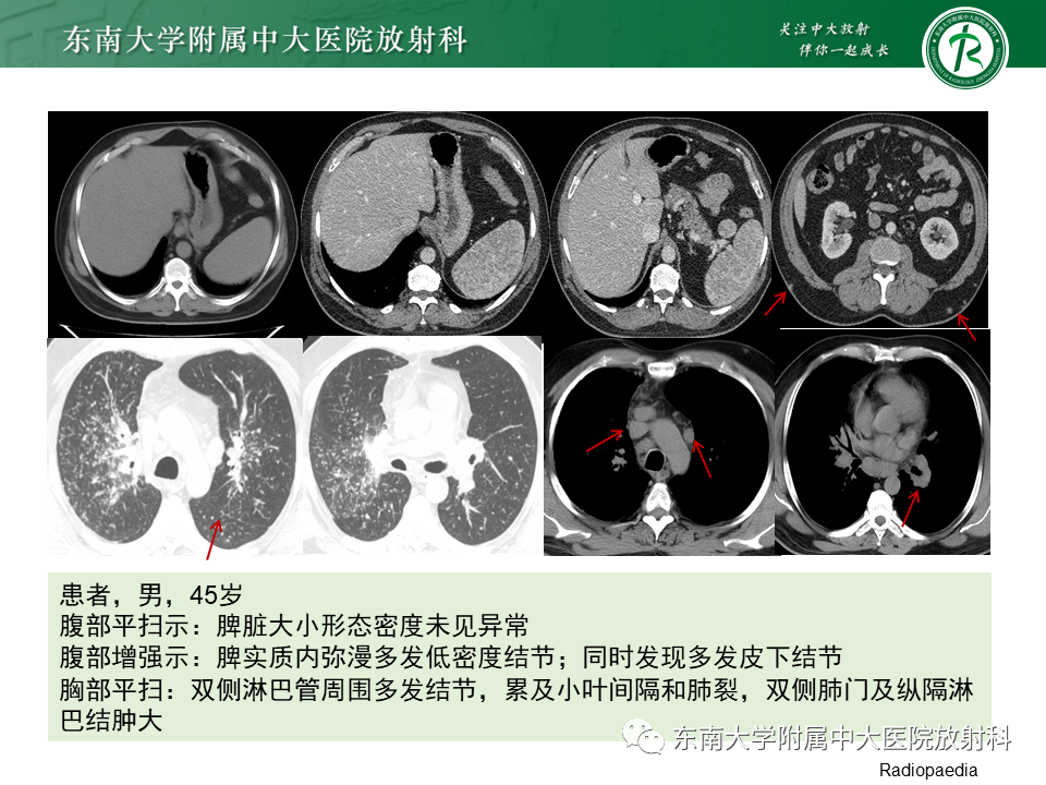 影像PPT - 【PPT】肺结节病-28
