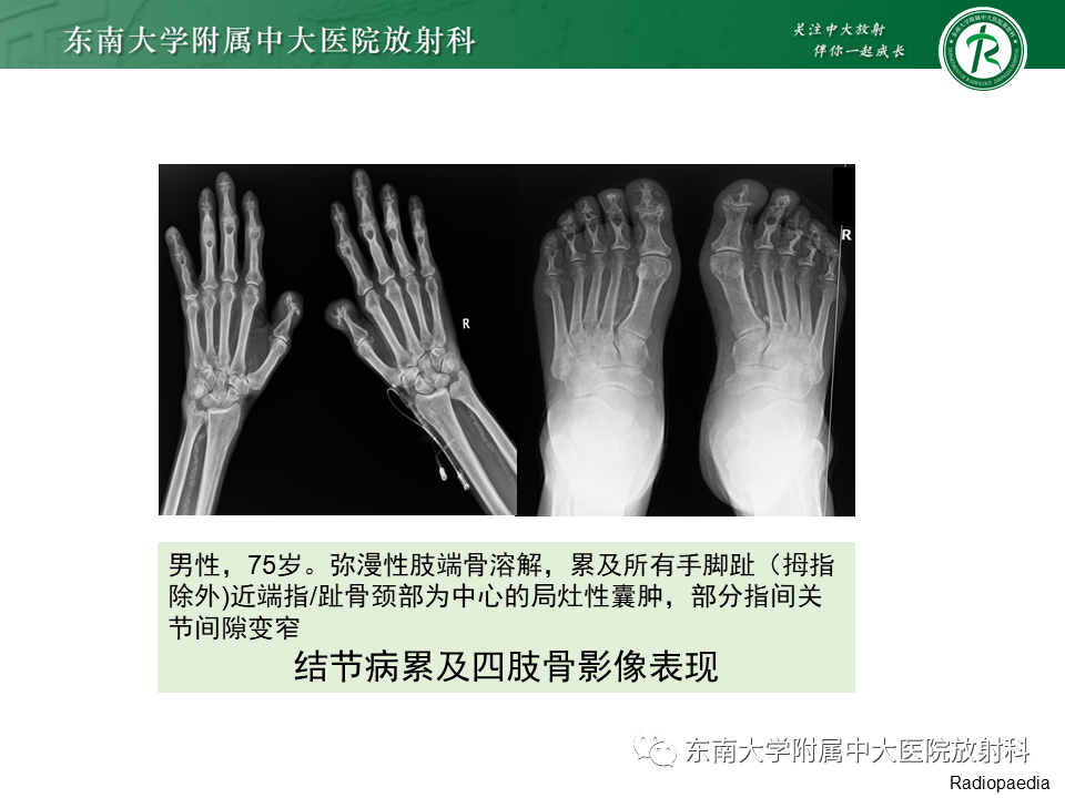 影像PPT - 【PPT】肺结节病-29