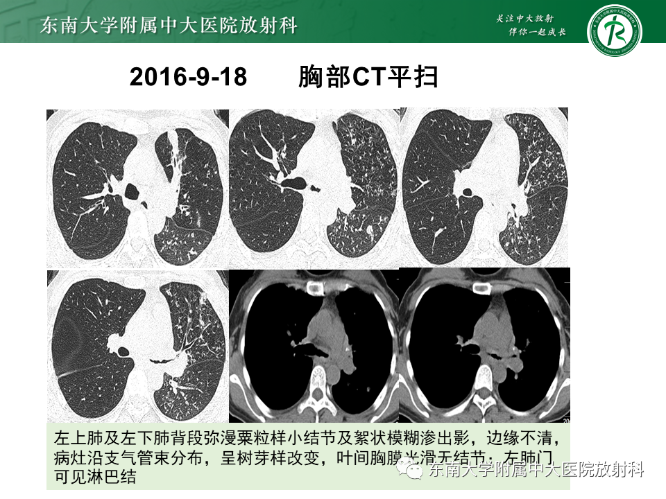 影像PPT - 【PPT】肺结节病-35