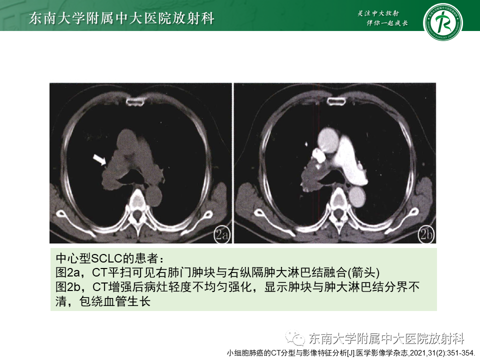 影像PPT - 【PPT】肺结节病-40