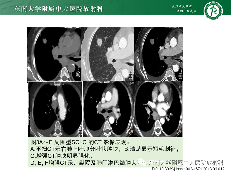 影像PPT - 【PPT】肺结节病-41