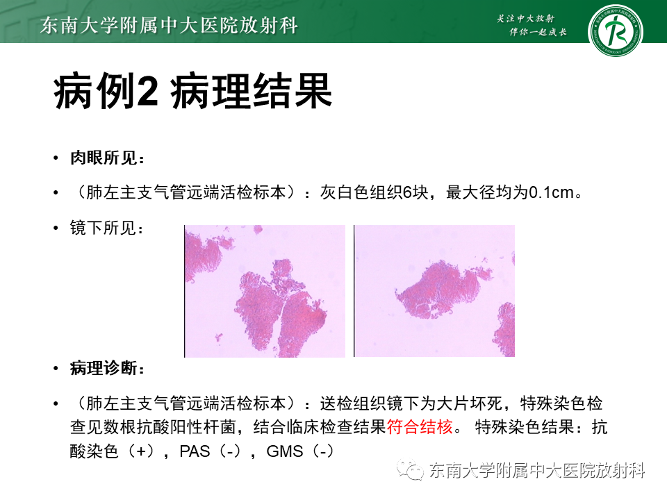 影像PPT - 【PPT】肺结节病-36