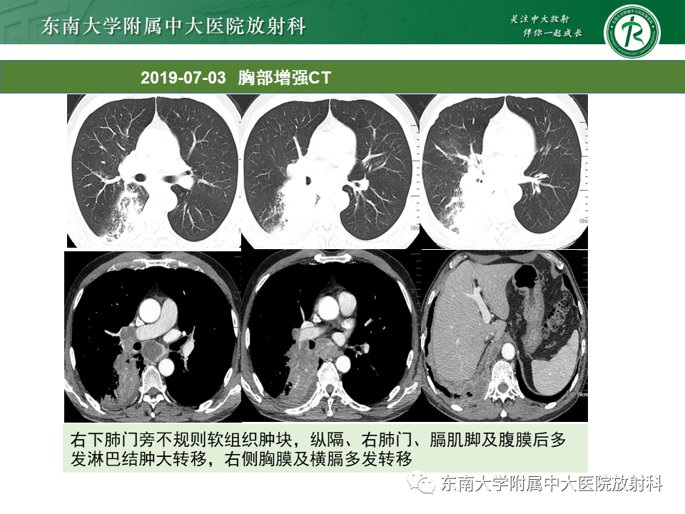 影像PPT - 【PPT】肺结节病-43