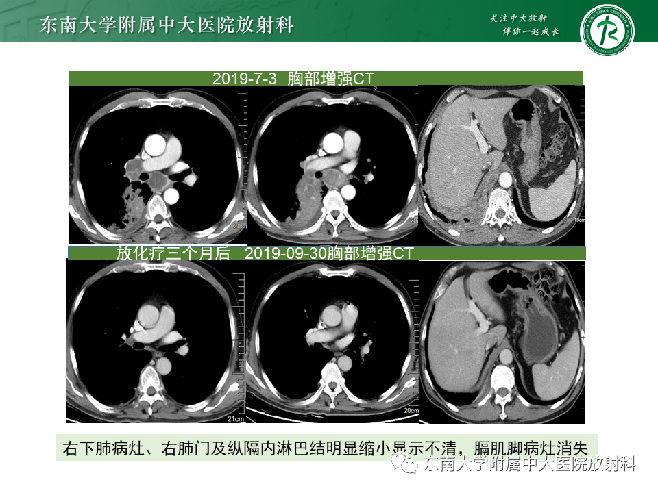 影像PPT - 【PPT】肺结节病-45