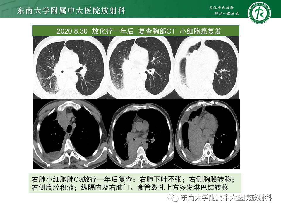 影像PPT - 【PPT】肺结节病-46
