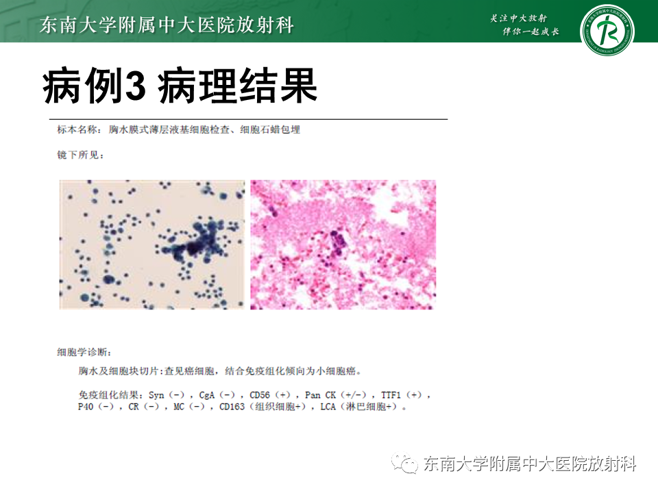 影像PPT - 【PPT】肺结节病-44