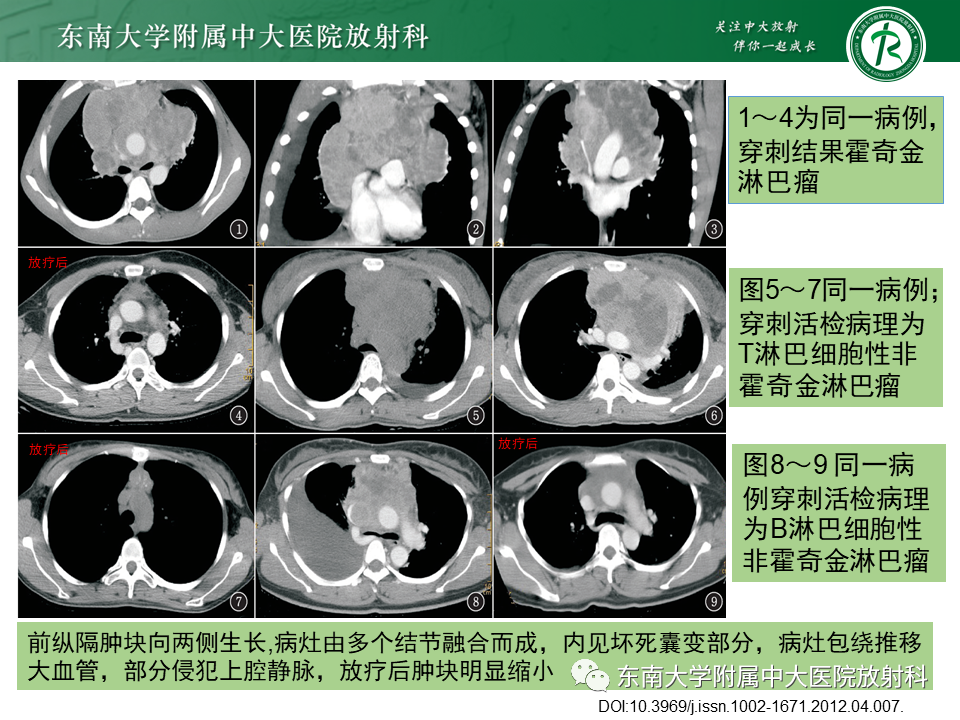 影像PPT - 【PPT】肺结节病-50