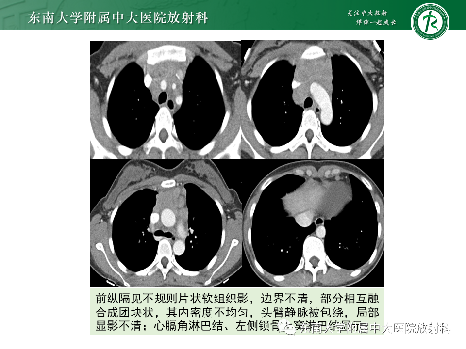 影像PPT - 【PPT】肺结节病-52