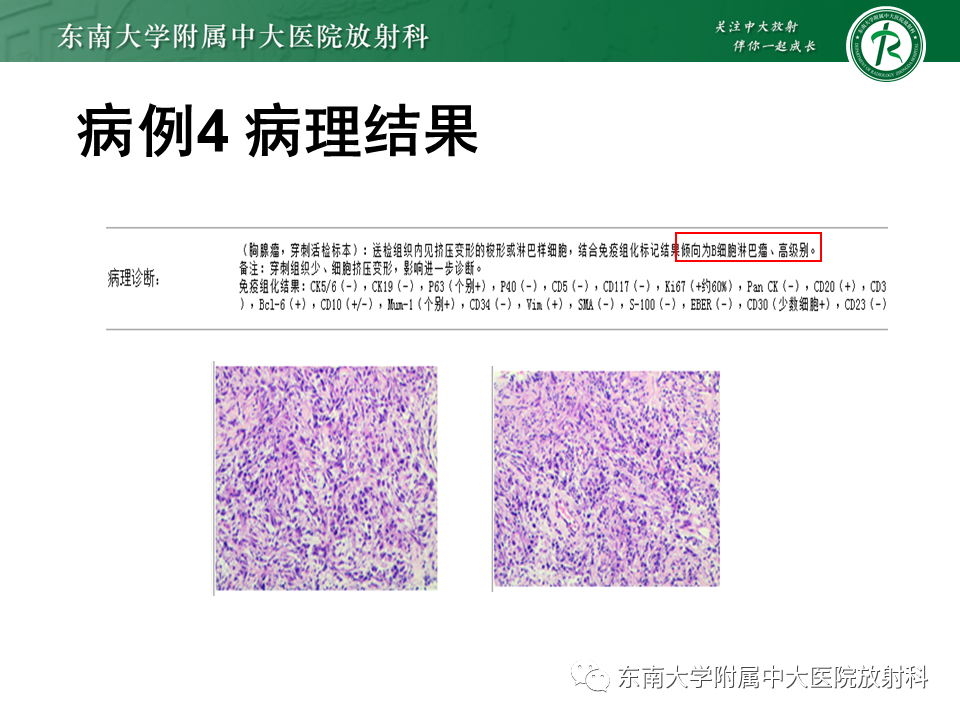 影像PPT - 【PPT】肺结节病-53