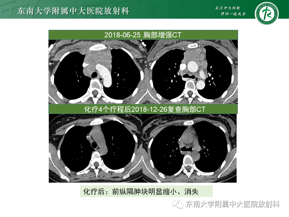 影像PPT - 【PPT】肺结节病-54