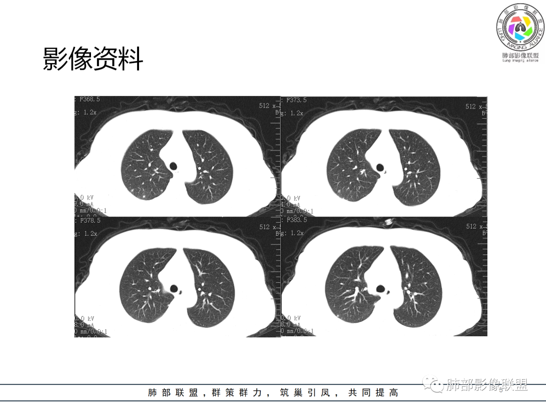 影像PPT - 【病例】经典的胸膜下病灶—隐球菌1例CT-5 影像PPT - 【病例】经典的胸膜下病灶—隐球菌1例CT-5