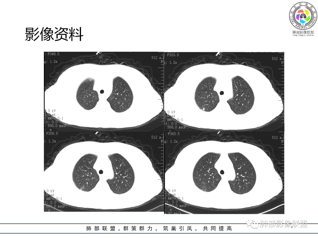 影像PPT - 【病例】经典的胸膜下病灶—隐球菌1例CT-4 影像PPT - 【病例】经典的胸膜下病灶—隐球菌1例CT-4