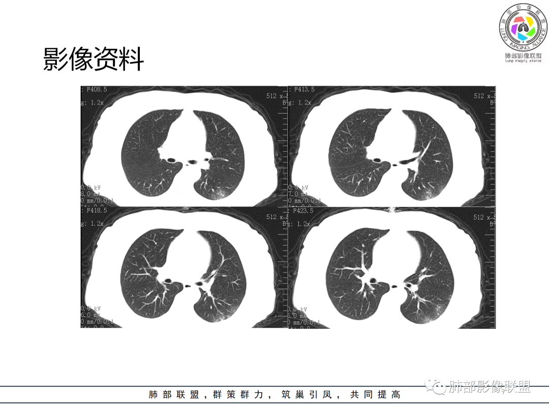 影像PPT - 【病例】经典的胸膜下病灶—隐球菌1例CT-7 影像PPT - 【病例】经典的胸膜下病灶—隐球菌1例CT-7