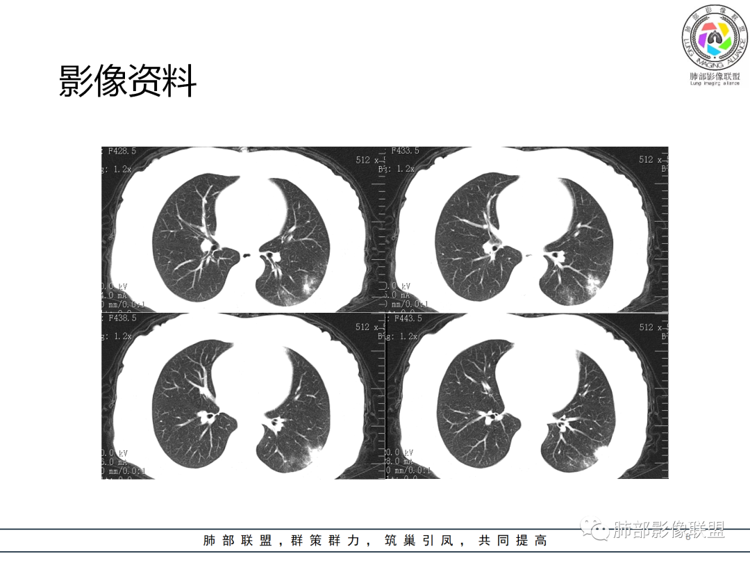 影像PPT - 【病例】经典的胸膜下病灶—隐球菌1例CT-8 影像PPT - 【病例】经典的胸膜下病灶—隐球菌1例CT-8