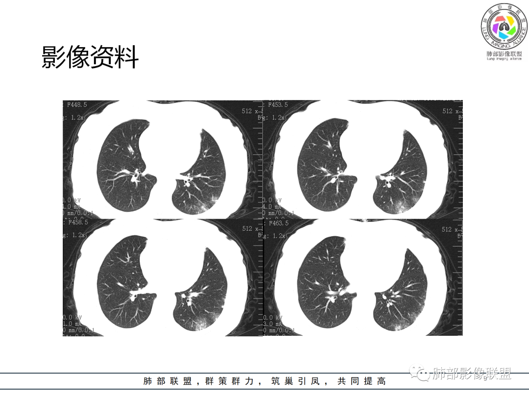 影像PPT - 【病例】经典的胸膜下病灶—隐球菌1例CT-9 影像PPT - 【病例】经典的胸膜下病灶—隐球菌1例CT-9
