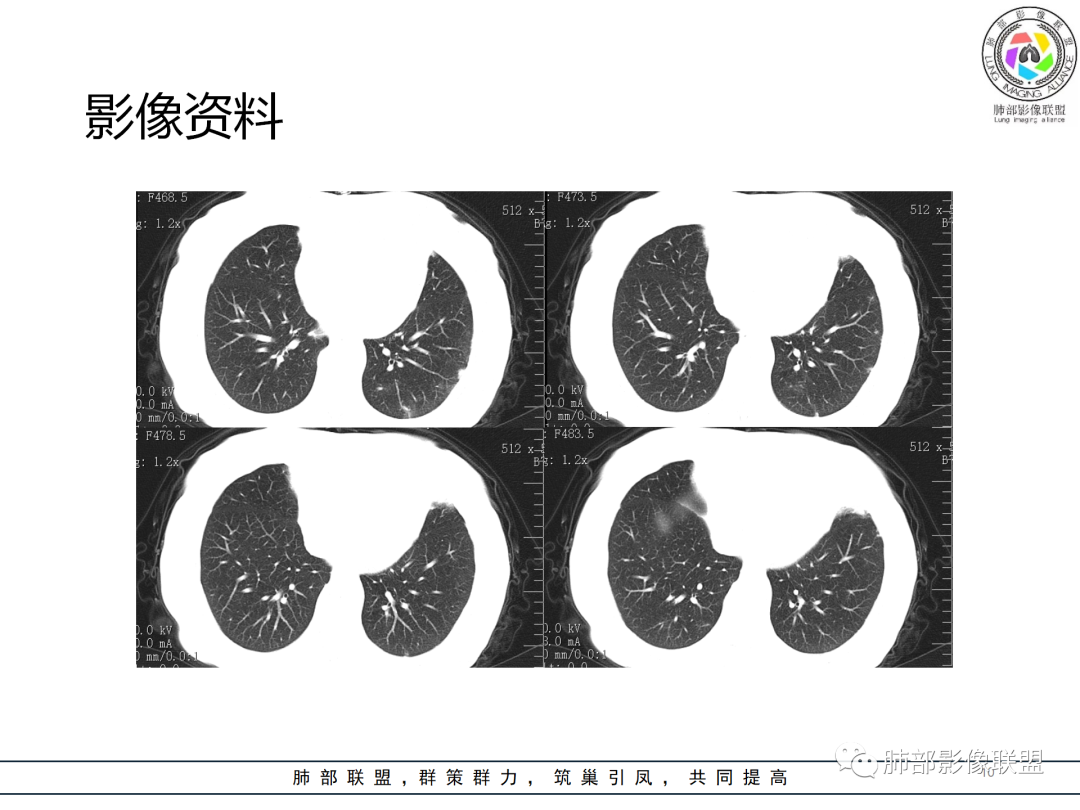 影像PPT - 【病例】经典的胸膜下病灶—隐球菌1例CT-10 影像PPT - 【病例】经典的胸膜下病灶—隐球菌1例CT-10