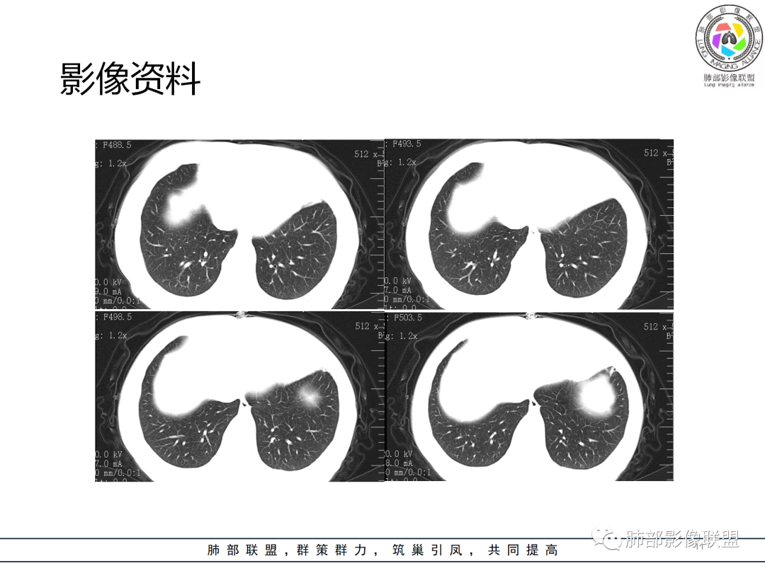影像PPT - 【病例】经典的胸膜下病灶—隐球菌1例CT-11 影像PPT - 【病例】经典的胸膜下病灶—隐球菌1例CT-11