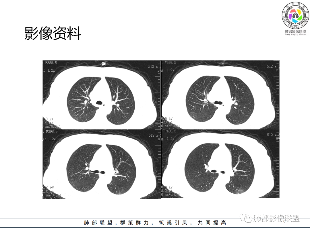 影像PPT - 【病例】经典的胸膜下病灶—隐球菌1例CT-6 影像PPT - 【病例】经典的胸膜下病灶—隐球菌1例CT-6