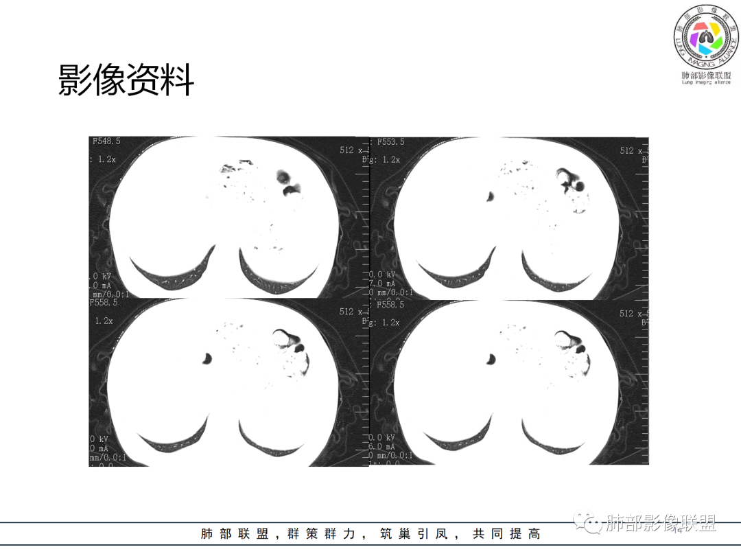 影像PPT - 【病例】经典的胸膜下病灶—隐球菌1例CT-14 影像PPT - 【病例】经典的胸膜下病灶—隐球菌1例CT-14