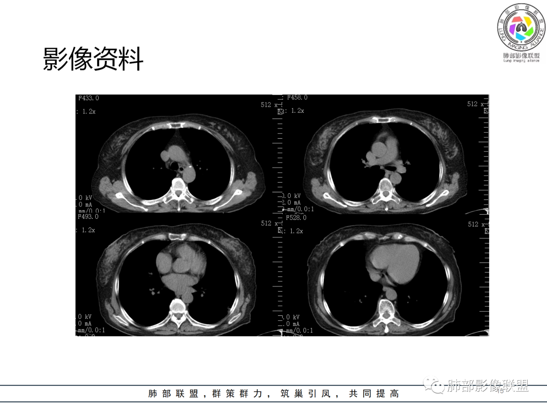 影像PPT - 【病例】经典的胸膜下病灶—隐球菌1例CT-15 影像PPT - 【病例】经典的胸膜下病灶—隐球菌1例CT-15