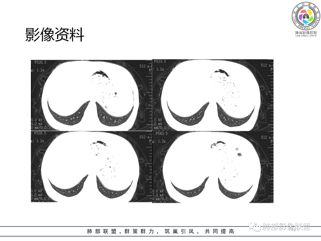 影像PPT - 【病例】经典的胸膜下病灶—隐球菌1例CT-13 影像PPT - 【病例】经典的胸膜下病灶—隐球菌1例CT-13
