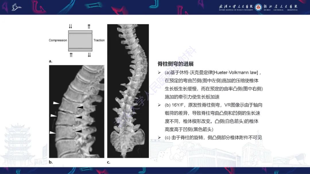 影像PPT - 【PPT】脊柱侧弯影像学评估-6