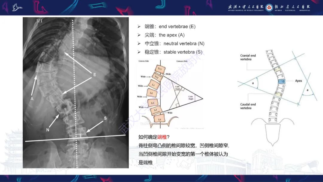影像PPT - 【PPT】脊柱侧弯影像学评估-10