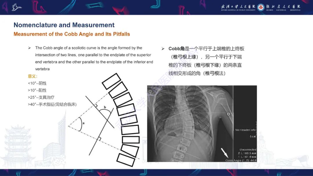 影像PPT - 【PPT】脊柱侧弯影像学评估-11