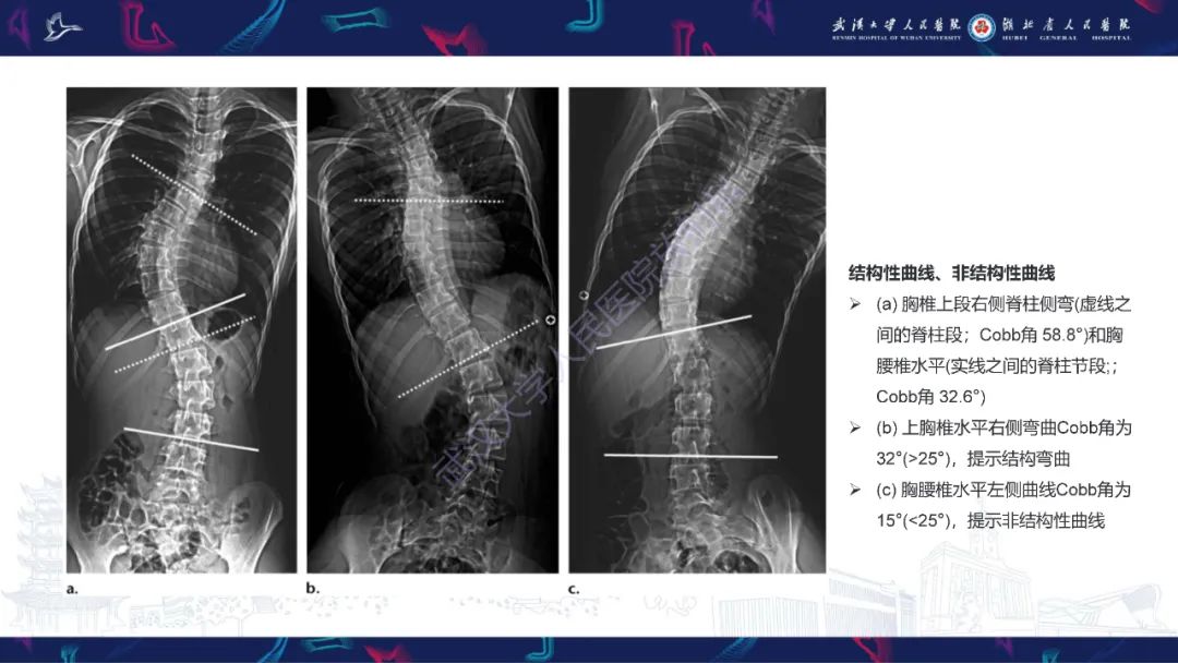 影像PPT - 【PPT】脊柱侧弯影像学评估-15