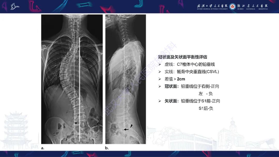 影像PPT - 【PPT】脊柱侧弯影像学评估-17