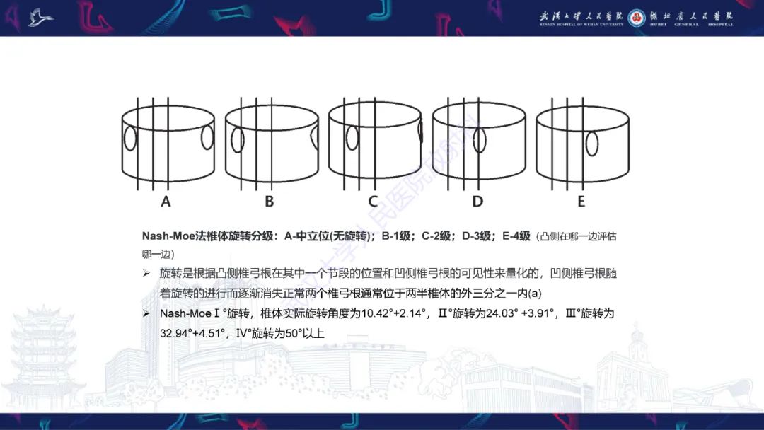 影像PPT - 【PPT】脊柱侧弯影像学评估-20