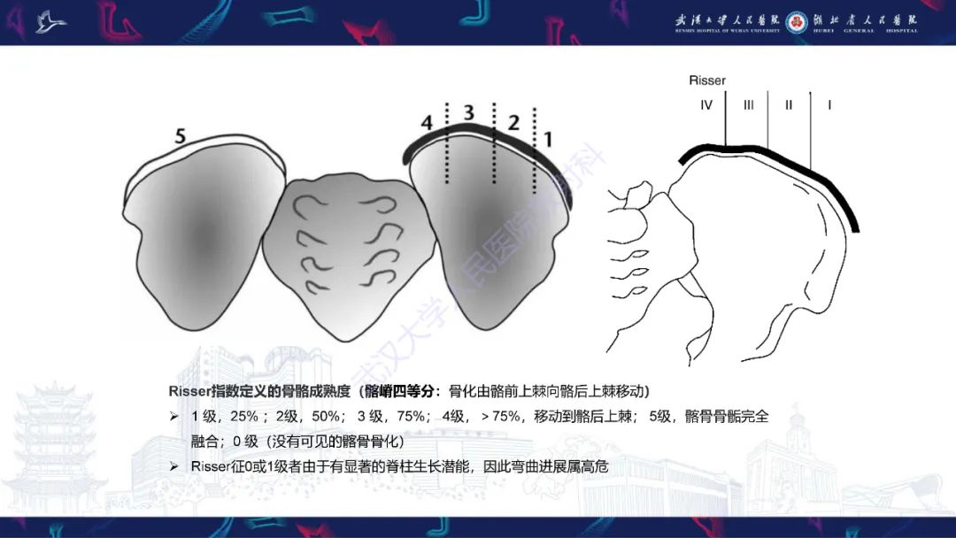 影像PPT - 【PPT】脊柱侧弯影像学评估-28